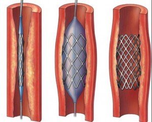Аортокоронарное шунтирование в Израиле