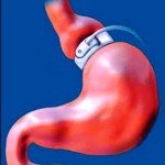 Бандажирование желудка