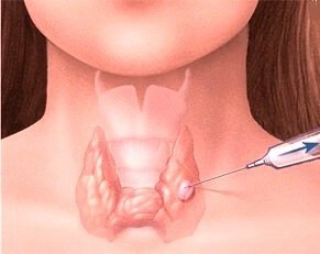 Биопсия под контролем КТ