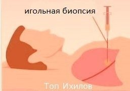 Биопсия
