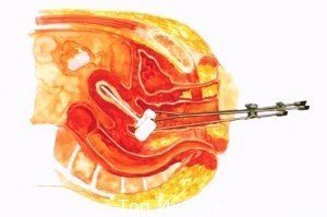 Брахитерапия