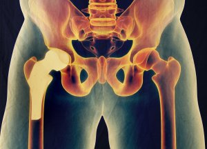 Замена тазобедренного сустава в Израиле