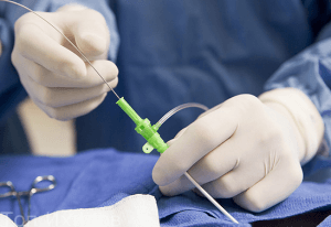 Эндоваскулярные вмешательства