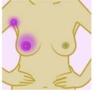 Гормональная терапия при раке молочной железы