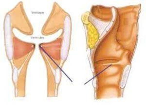 Ларингопластика в Израиле