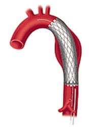 Лечебная ангиография