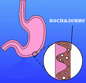 Лечение гастрита в Топ Ихилов