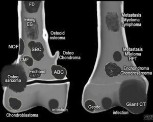 Лечение метастазов в костях