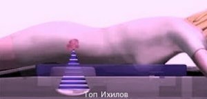 Лечение онкологии в Израиле