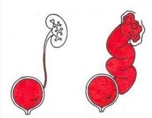 Лечение пузырно-мочеточникового рефлюкса