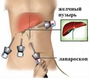 Лапароскопическая операция на желчном пузыре