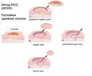 Оперативное лечение злокачественных новообразований кожи по методу МОС в Израиле