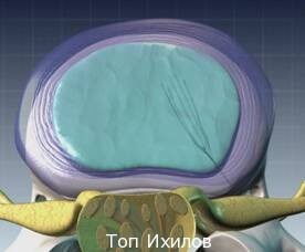 Перкутанная нуклеопластика