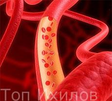 Плазмаферез