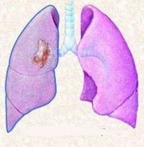 Пневмонэктомия