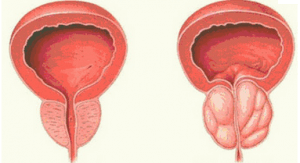 Рак предстательной железы