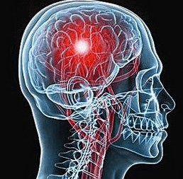 Современные методы хирургического лечения опухолевых новообразований головного мозга в Израиле