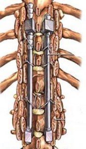 Лечение сколиоза в Израиле Spinal Fusion