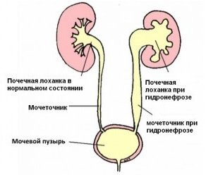 Стеноз основания почечной лоханки