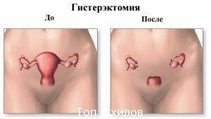 Удаление матки