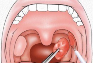 Удаление миндалин (гланд) лазером