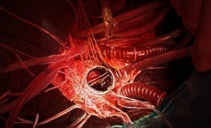 Замена клапана сердца в Израиле