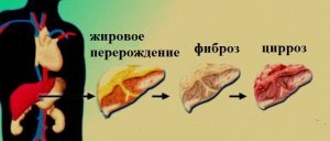 Заболевание печени и желчных протоков