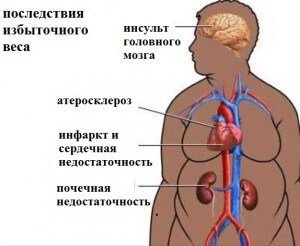 Лечение ожирения в Израиле