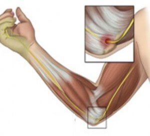 Компрессия локтевого нерва