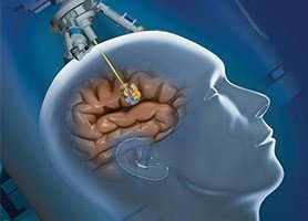 удаление опухолей