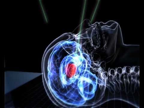 Радиохирургические операции