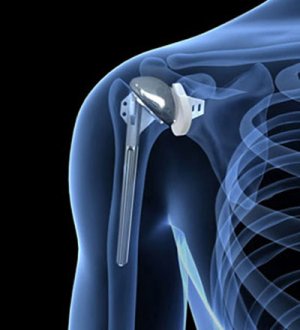 Эндопротезирование плечевого сустава в Израиле